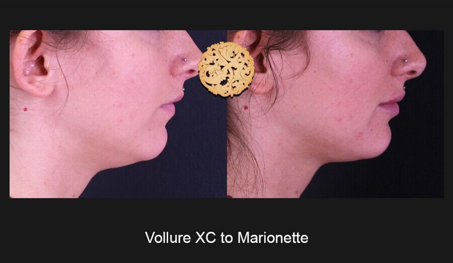 Marionette Filler Before & After