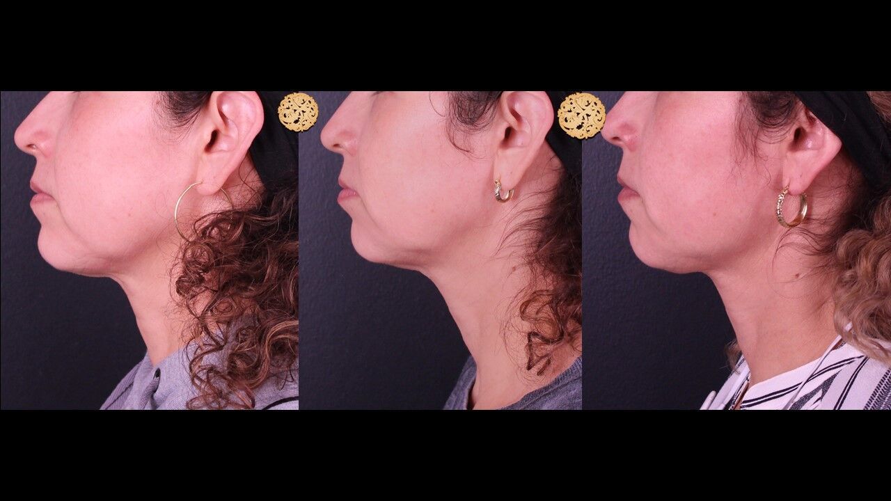 Marionette Filler Before & After