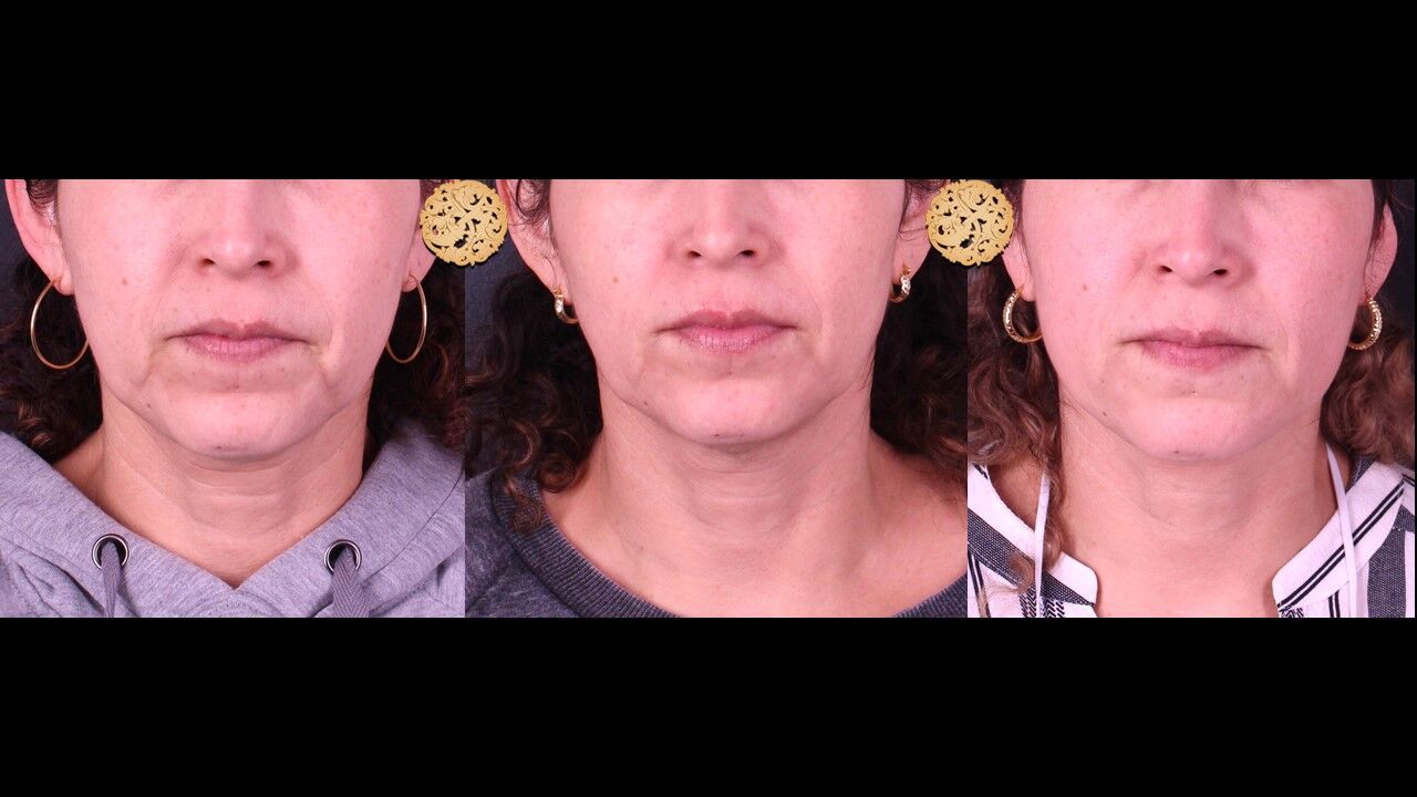 Marionette Filler Before & After