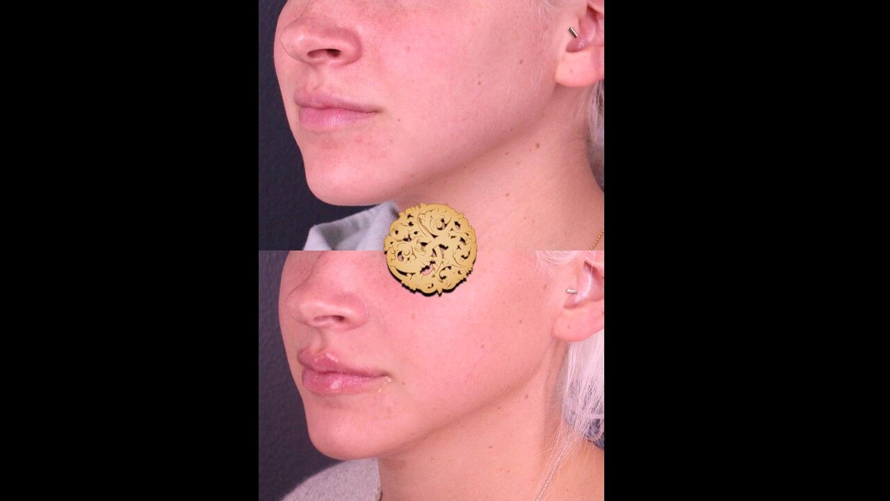 Marionette Filler Before & After