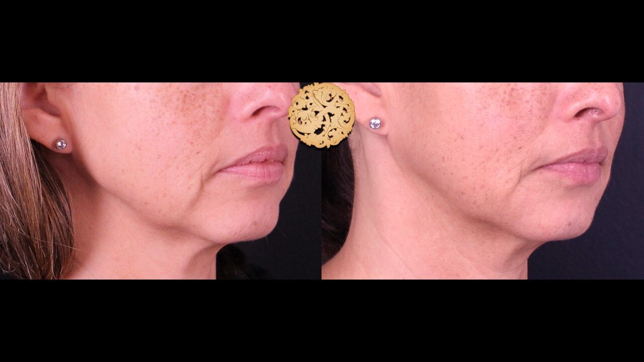 Marionette Filler Before & After