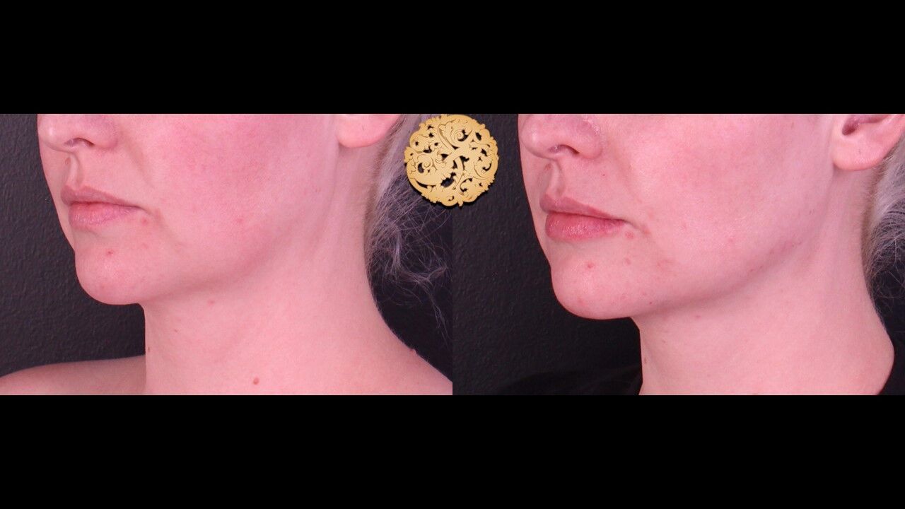 Marionette Filler Before & After