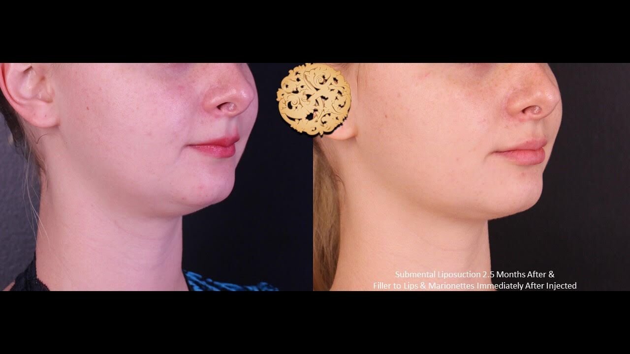 Marionette Filler Before & After