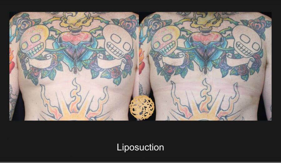 Male Body Contouring Before & After