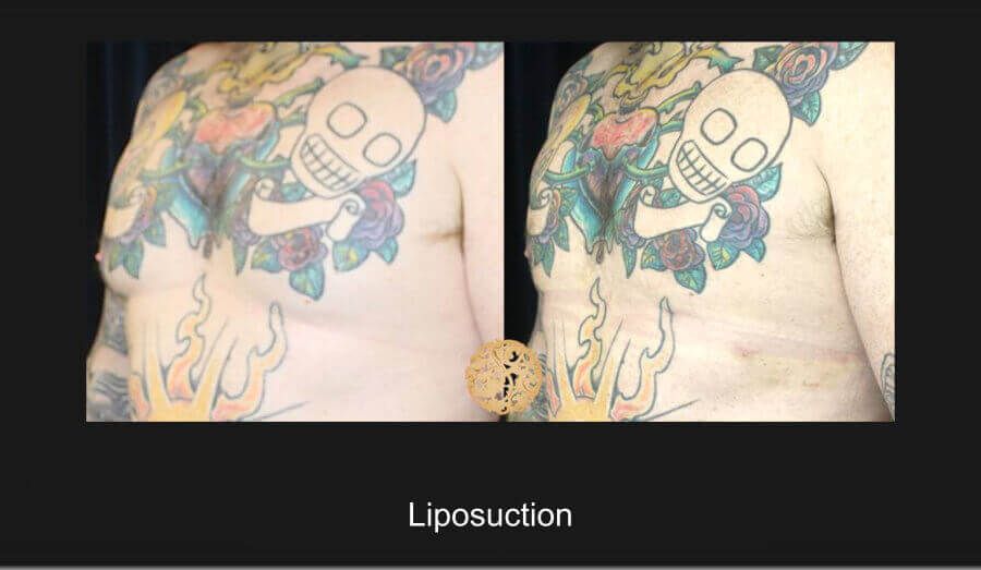 Male Body Contouring Before & After