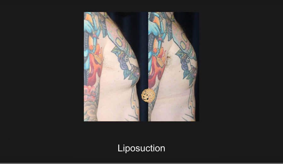 Male Body Contouring Before & After