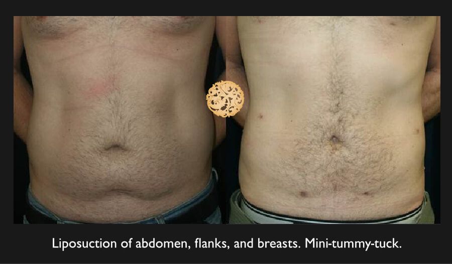 Male Body Contouring Before & After