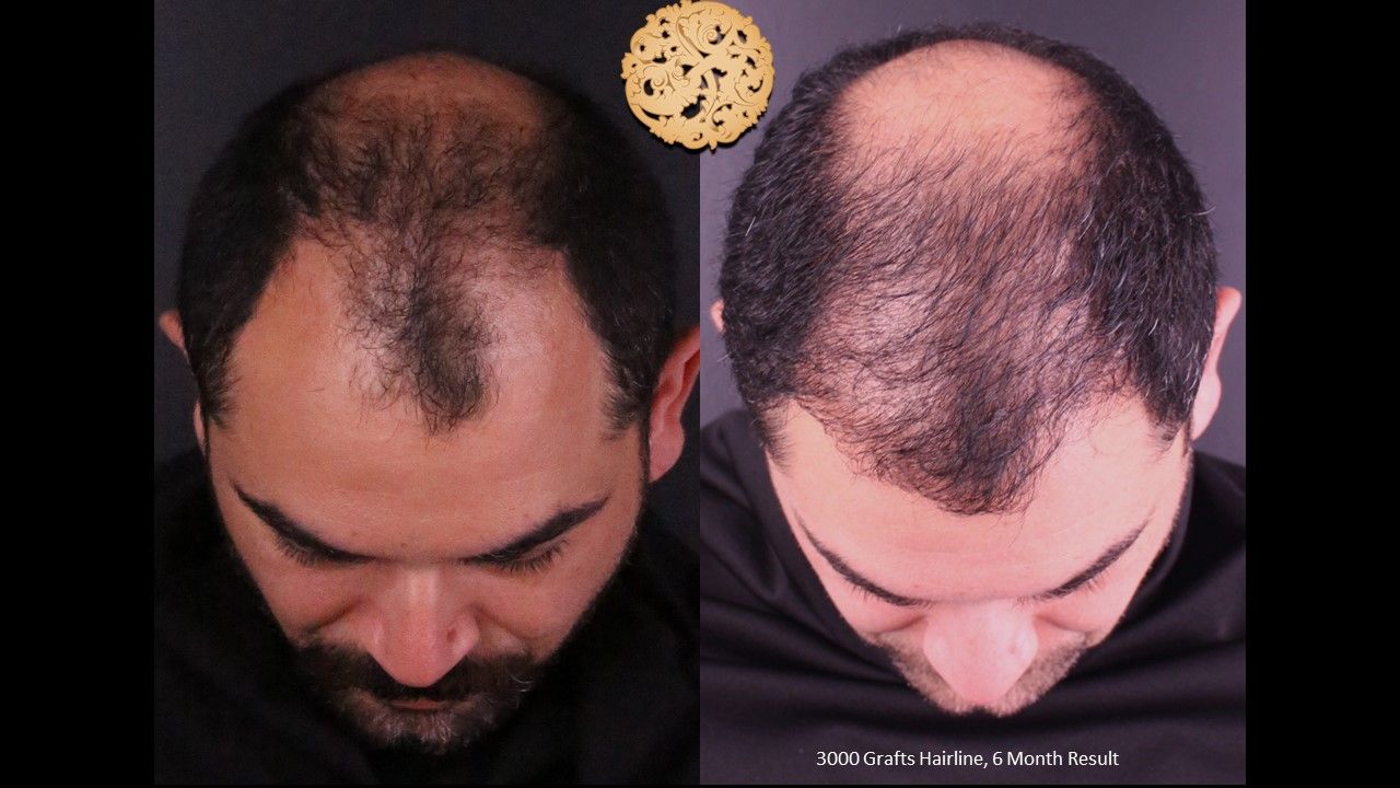 Hair Transplant Before & After