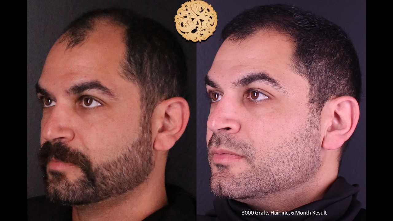 Hair Transplant Before & After