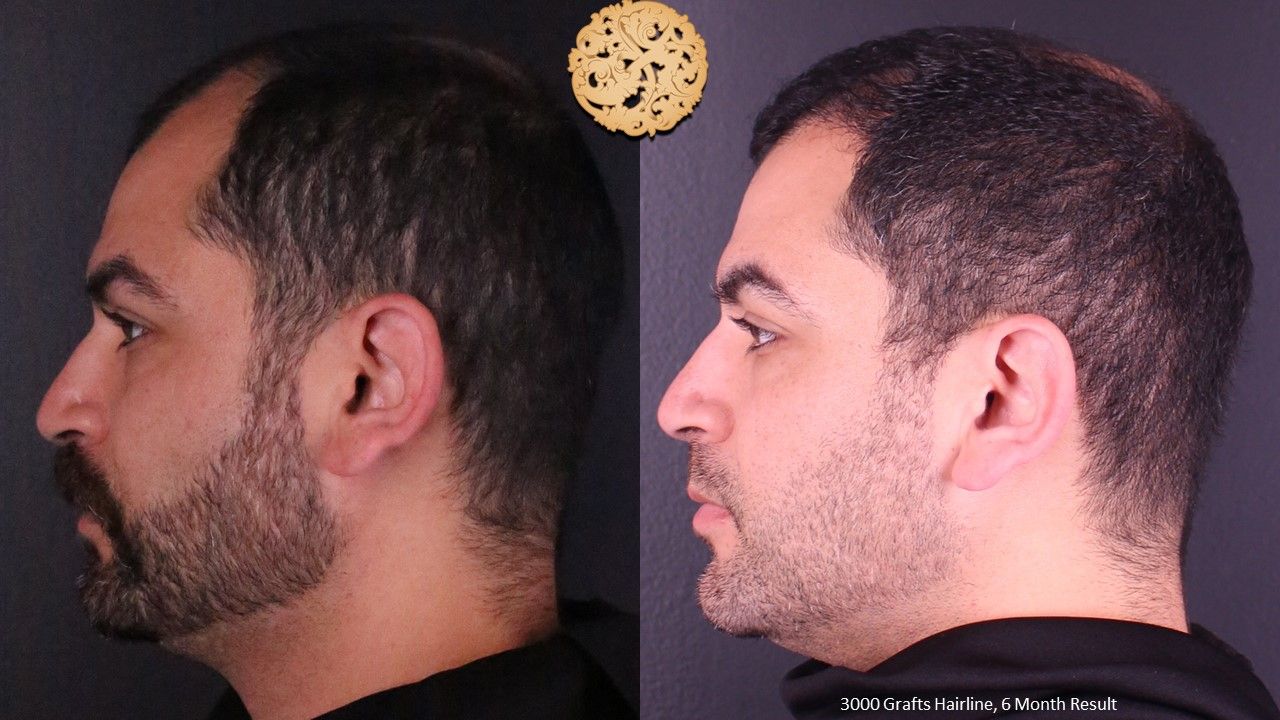 Hair Transplant Before & After