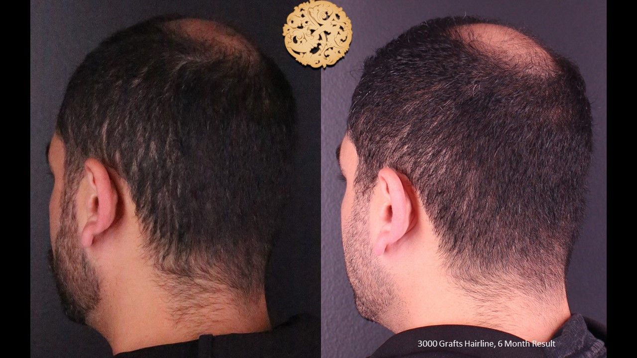 Hair Transplant Before & After