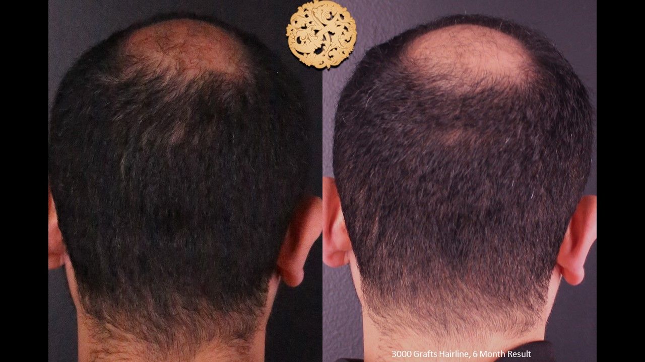 Hair Transplant Before & After