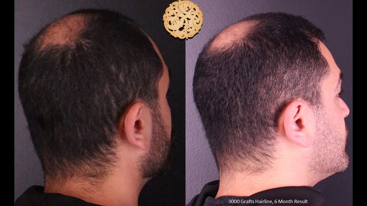 Hair Transplant Before & After