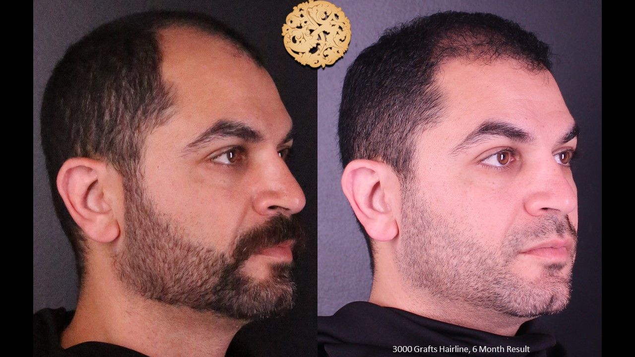 Hair Transplant Before & After