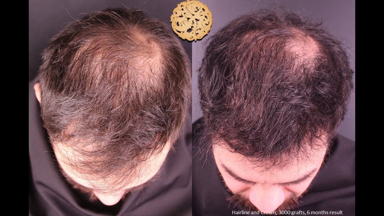 Hair Transplant Before & After