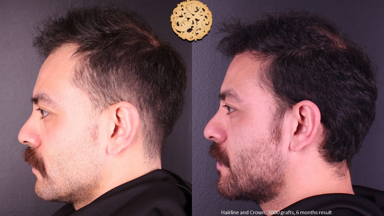 Hair Transplant Before & After