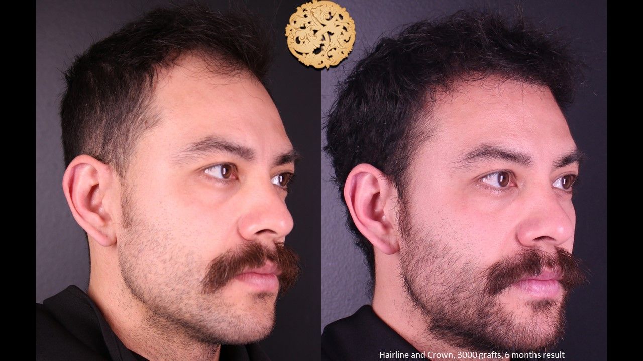 Hair Transplant Before & After