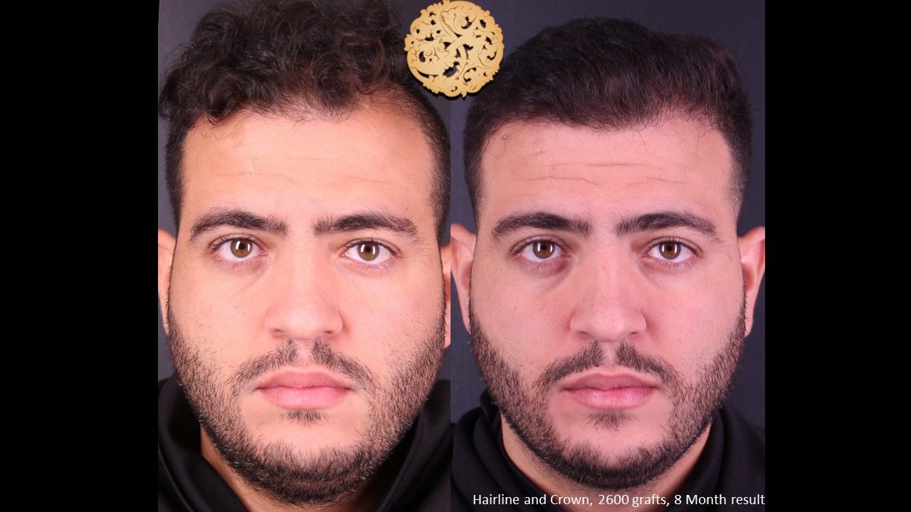 Hair Transplant Before & After