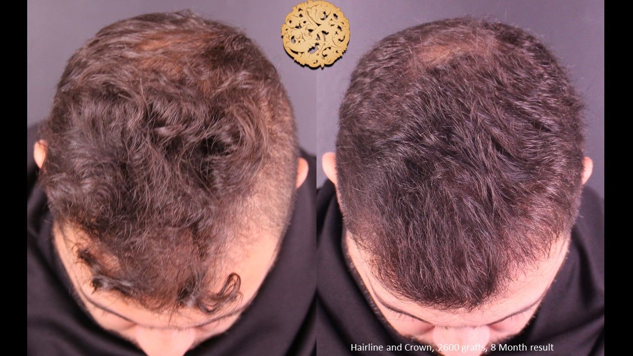 Hair Transplant Before & After