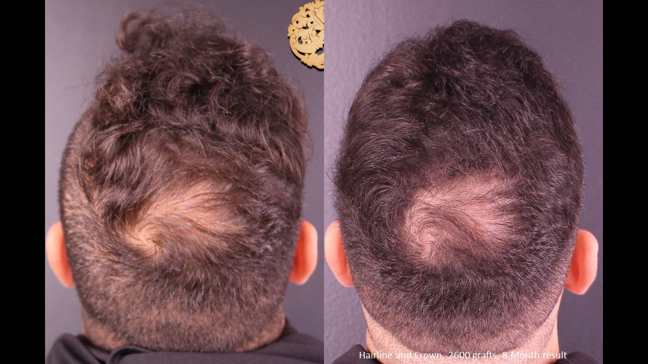 Hair Transplant Before & After