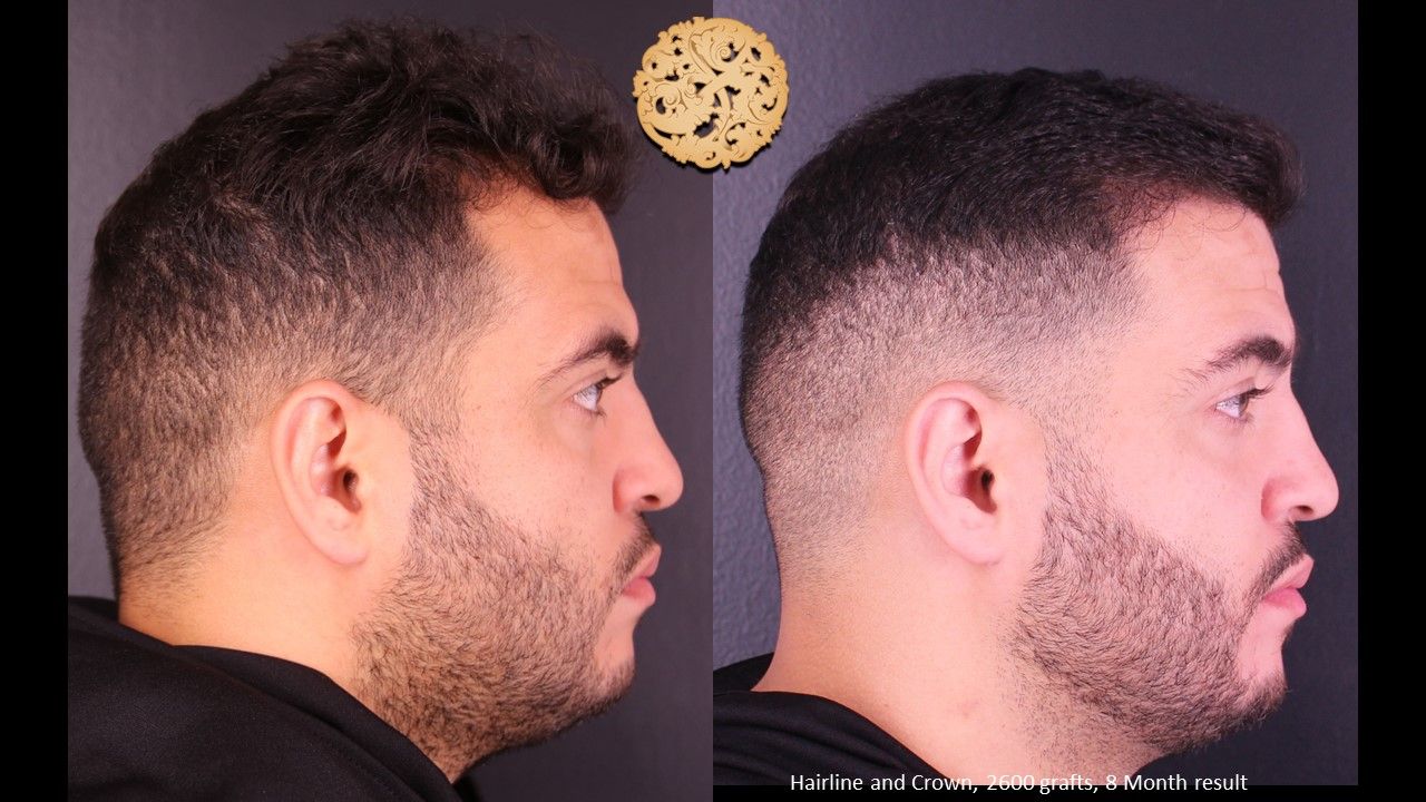 Hair Transplant Before & After