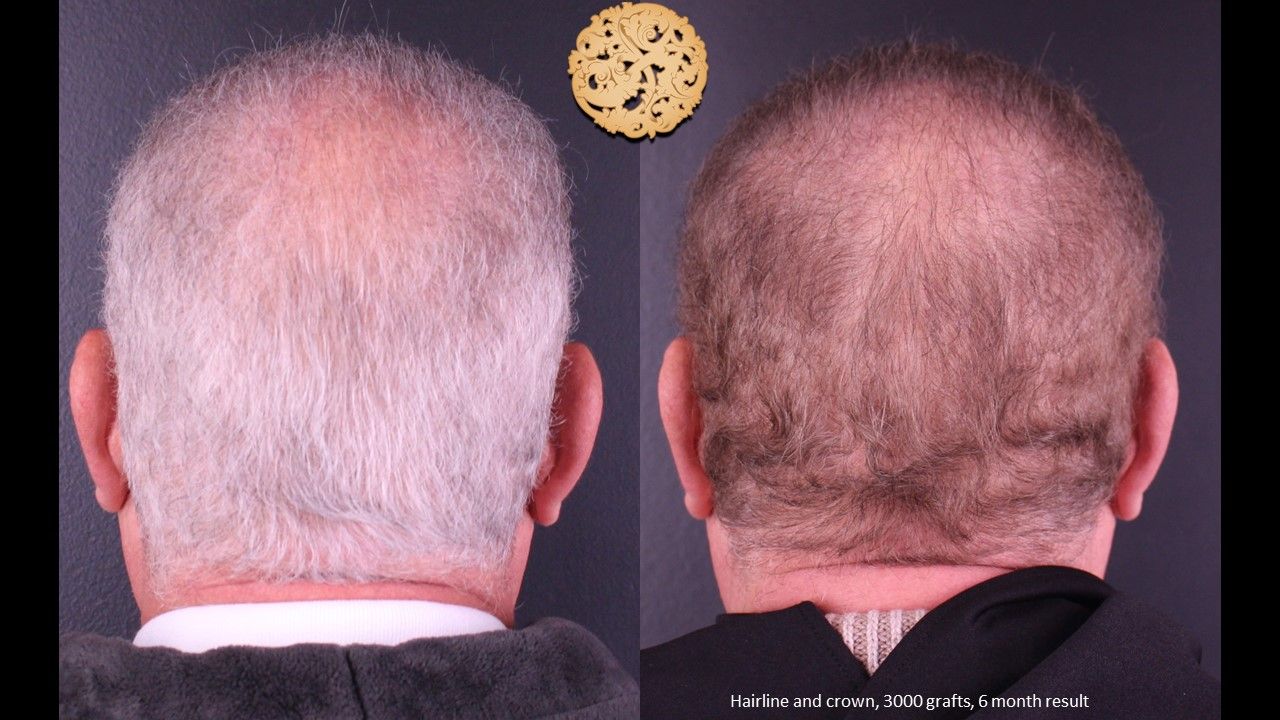 Hair Transplant Before & After