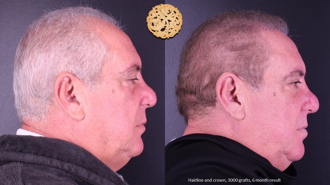 Hair Transplant Before & After