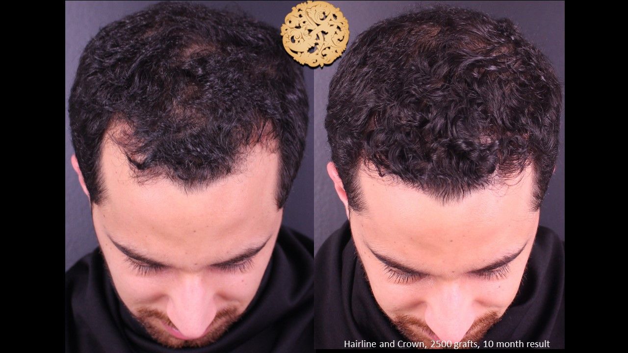 Hair Transplant Before & After