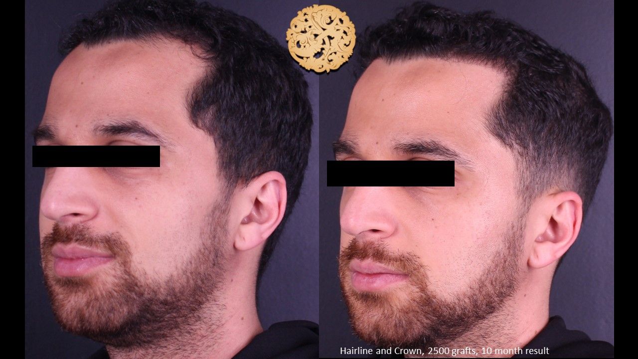 Hair Transplant Before & After