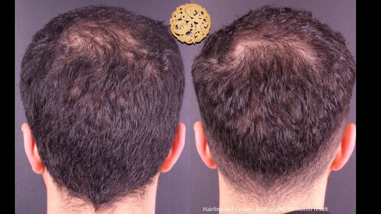 Hair Transplant Before & After