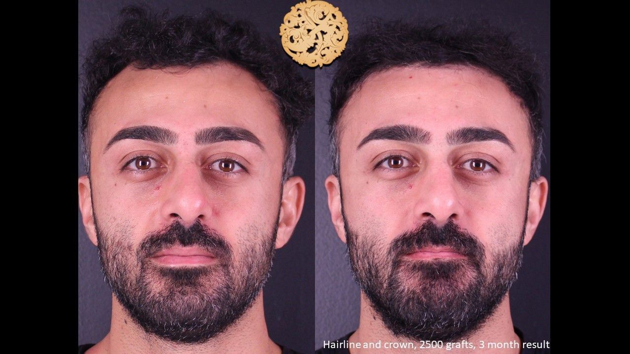 Hair Transplant Before & After