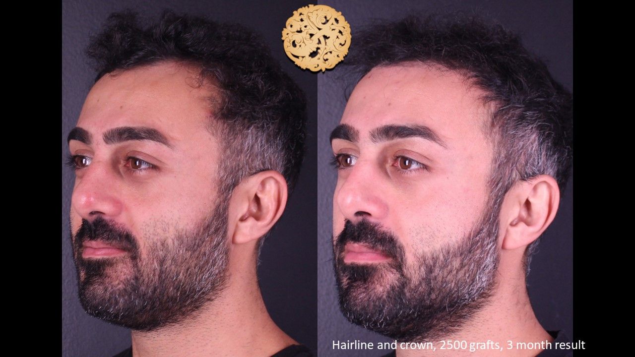 Hair Transplant Before & After