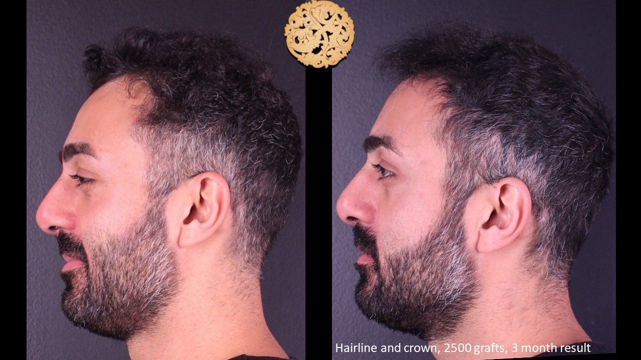 Hair Transplant Before & After