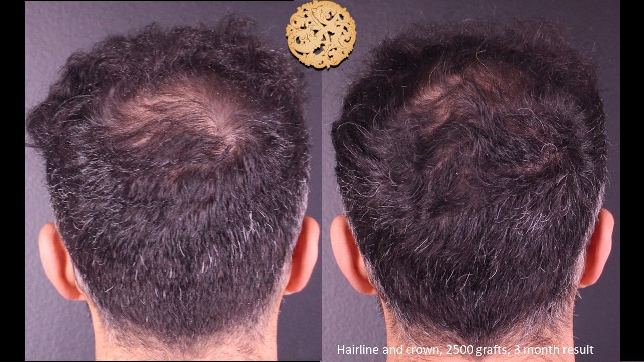 Hair Transplant Before & After