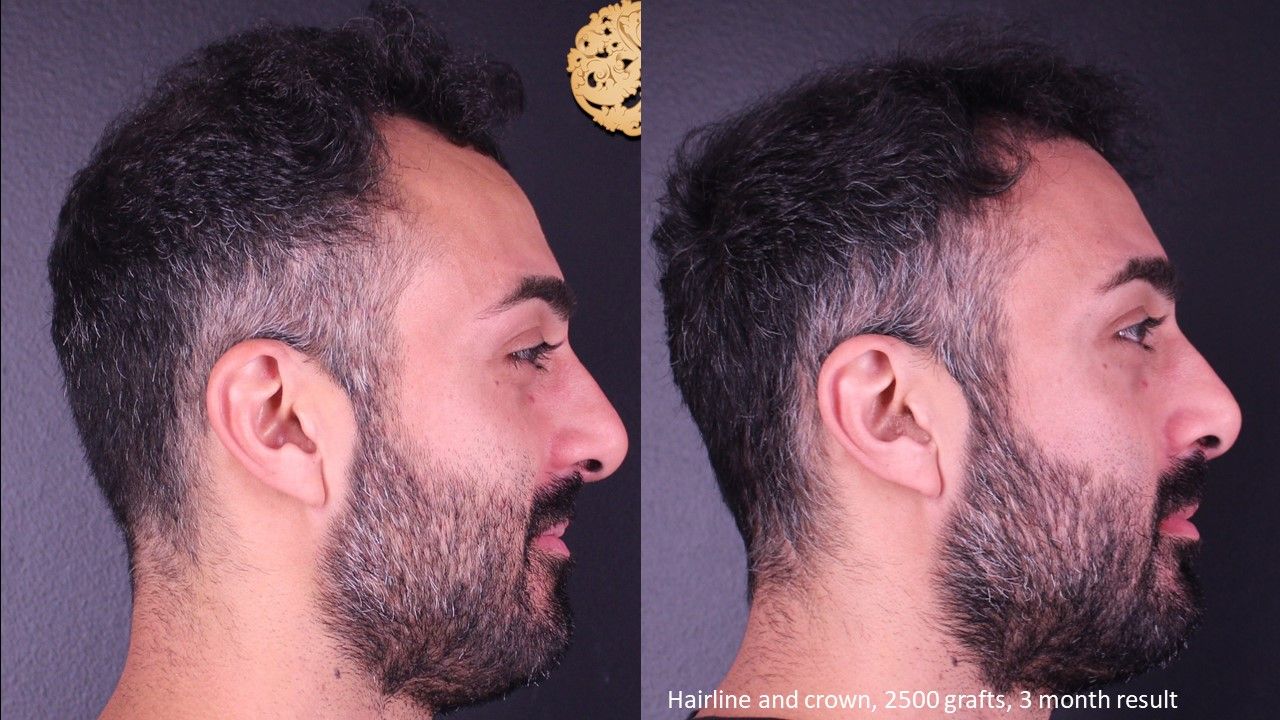 Hair Transplant Before & After