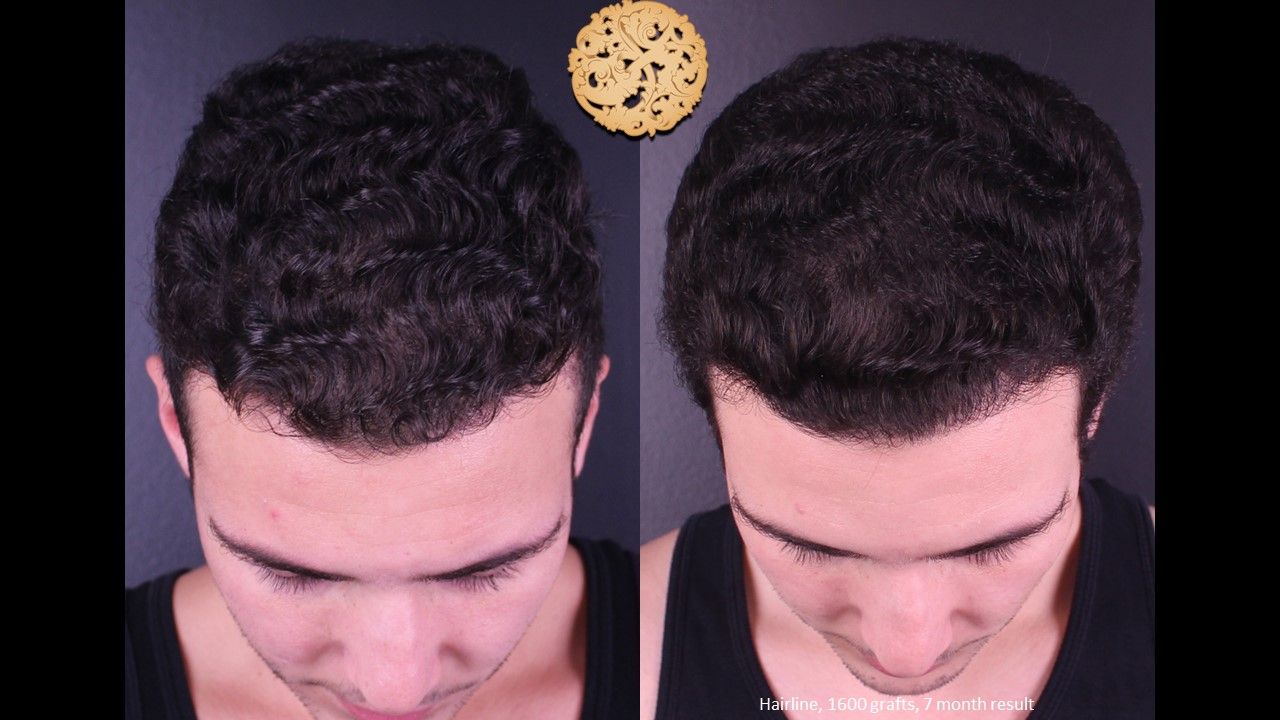 Hair Transplant Before & After