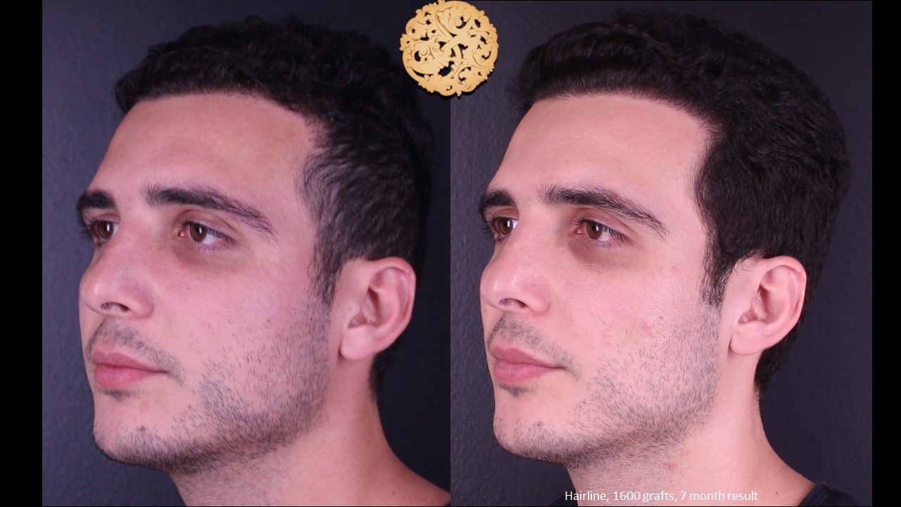 Hair Transplant Before & After