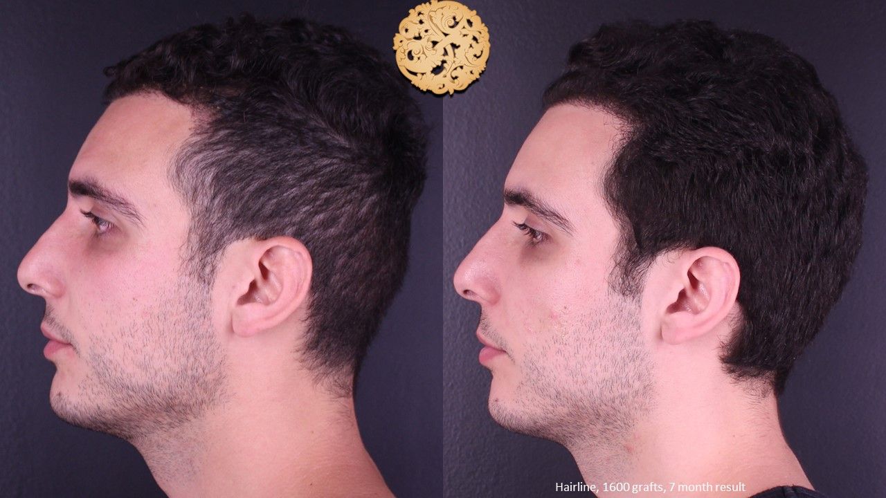 Hair Transplant Before & After