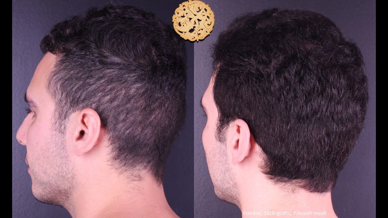 Hair Transplant Before & After