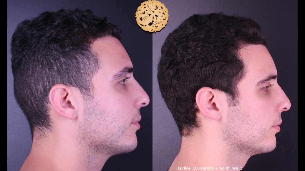 Hair Transplant Before & After