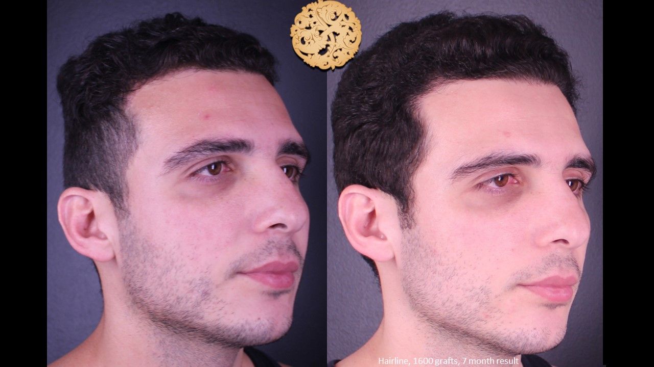 Hair Transplant Before & After