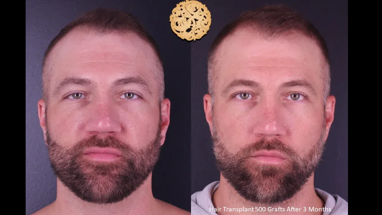 Hair Transplant Before & After