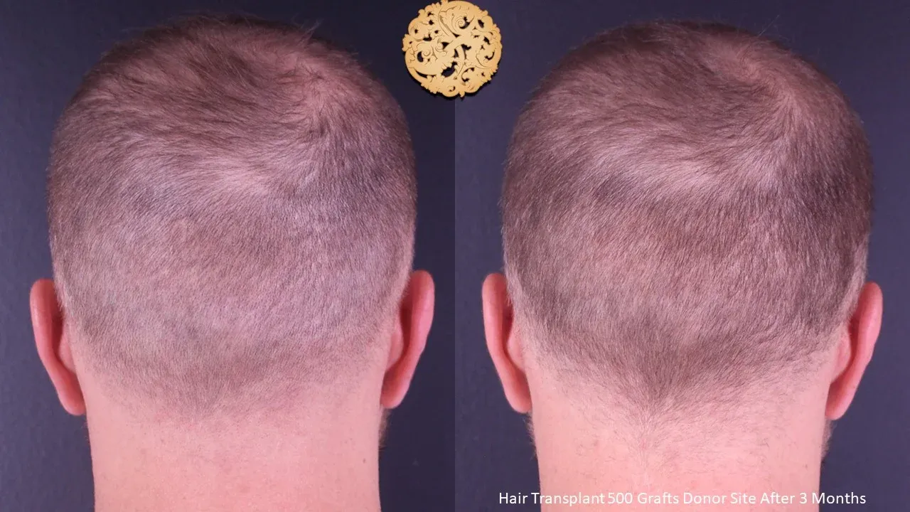 Hair Transplant Before & After