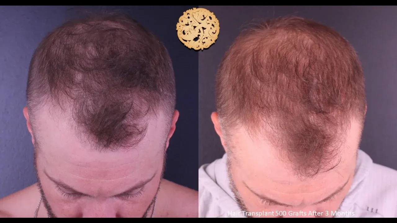 Hair Transplant Before & After