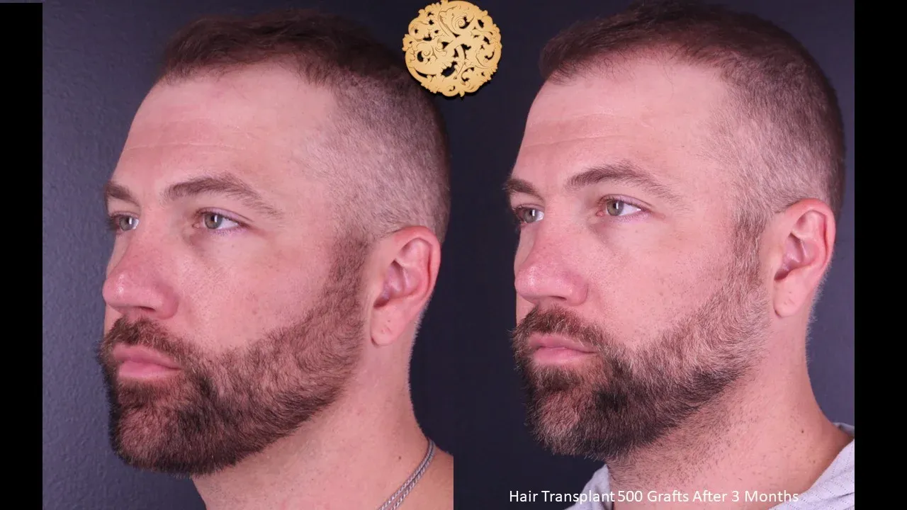 Hair Transplant Before & After