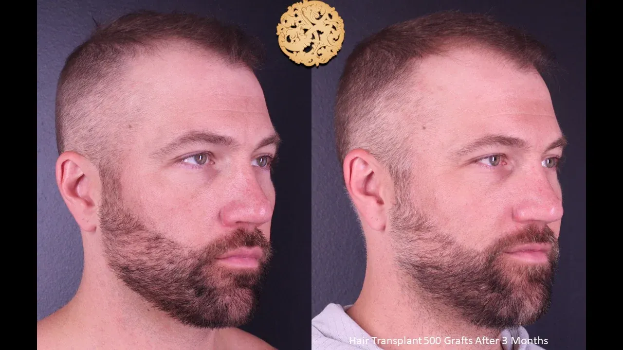 Hair Transplant Before & After