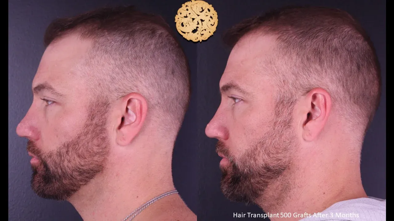 Hair Transplant Before & After