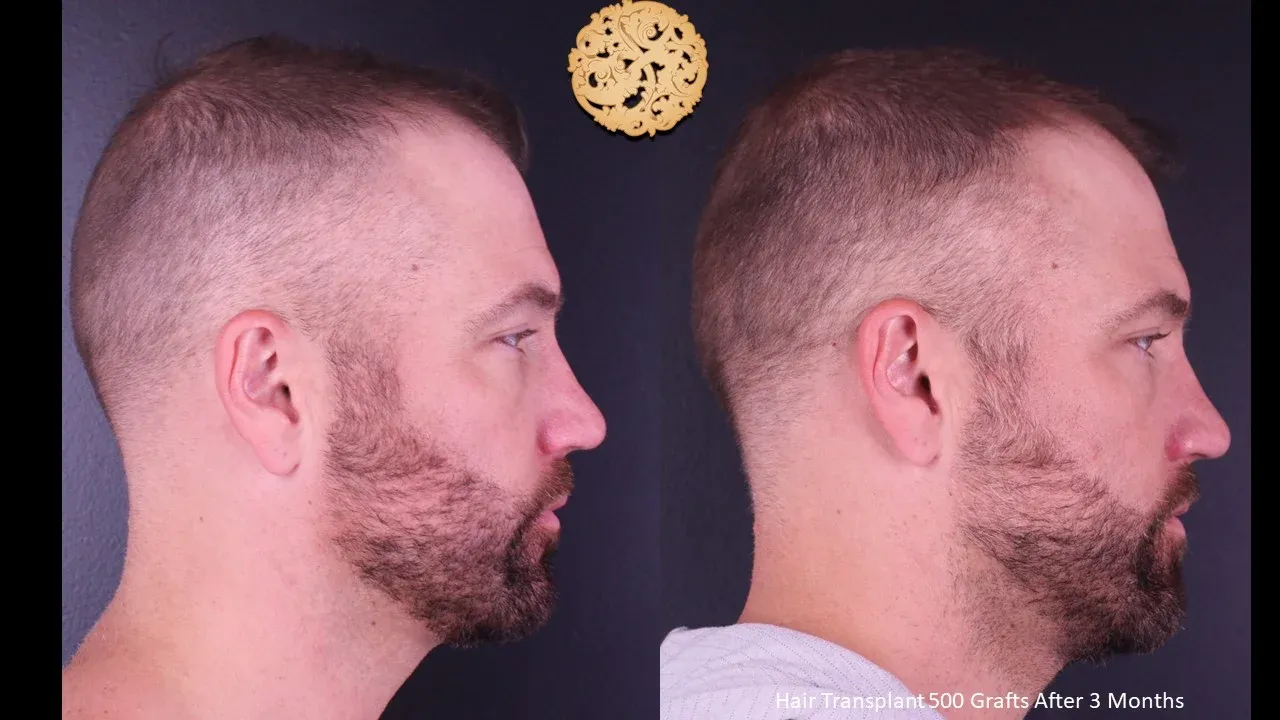 Hair Transplant Before & After