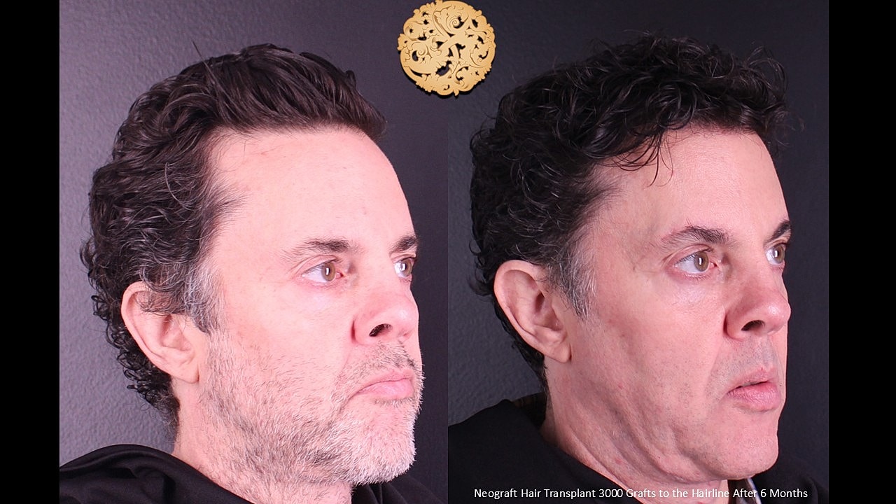 Hair Transplant Before & After