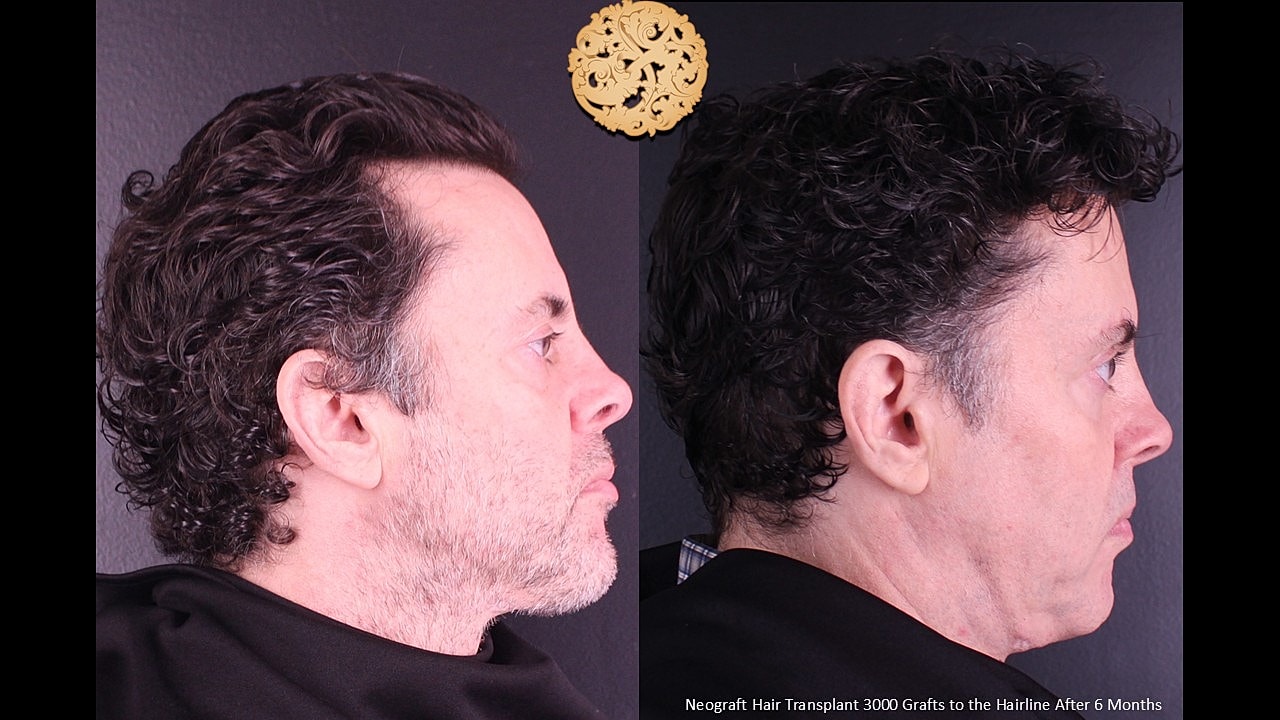 Hair Transplant Before & After
